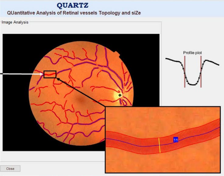 Завдяки ШІ можна буде прогнозувати ризик серцево-судинних захворювань, скануючи сітківку ока