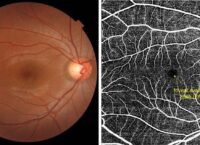Завдяки ШІ можна буде прогнозувати ризик серцево-судинних захворювань, скануючи сітківку ока