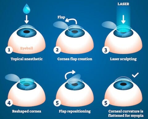 Лазерна корекція зору на власному досвіді: нехай наука працює на вас