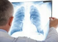 Щоденна таблетка знижує ризик смерті від раку легенів на 51%, – дослідження