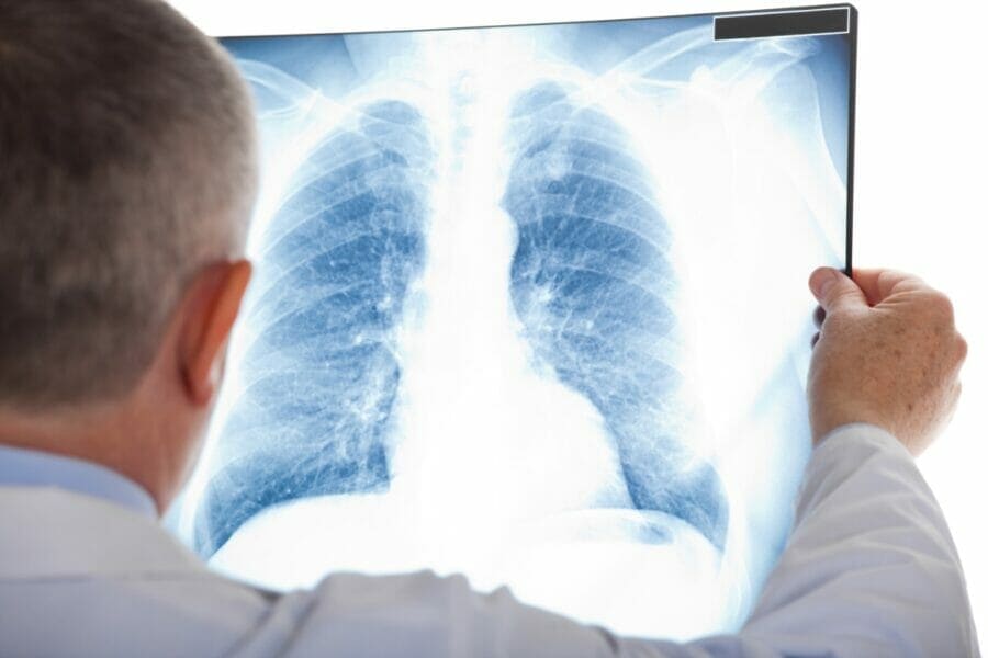 Щоденна таблетка знижує ризик смерті від раку легенів на 51%, – дослідження